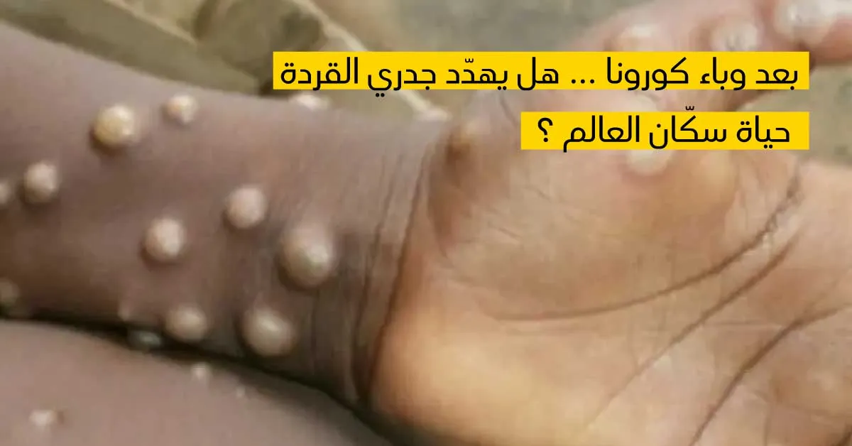 بعد وباء كورونا ... هل يهدّد جدري القردة حياة سكّان العالم ؟